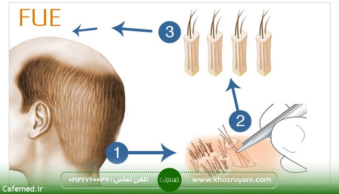 بهترین روش کاشت مو با تضمین بدون ریزش چیست ؟
